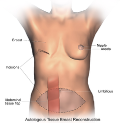 Breast reconstruction using autologous tissue (TRAM).