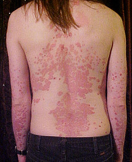 Jongeman met plaque psoriasis op rug en armen