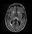 Axial MRI FLAIR image showing hyperintense signal in the mesial dorsal thalami, a common finding in Wernicke encephalopathy. This patient was nearly in coma when IV thiamine was started, he responded moderately well but was left with some Korsakoff type deficits.