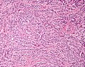 Low magnification micrograph of a Sertoli cell tumour. H&E stain.