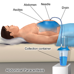 Abdominal paracentesis.