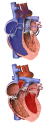 Arterial switch procedure to correct dextro-Transposition of the great arteries.