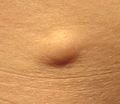 Lipoma[6]