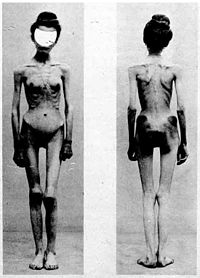 Anoreksia nervosa -potilas Ranskasta vuodelta 1900.