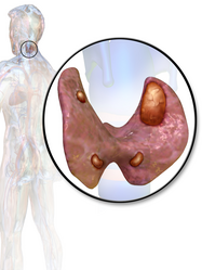 Parathyroid adenoma.