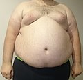 肥胖症男性的皮膚擴張紋