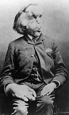 Joseph Merrick, cca 1889