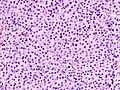 Micrograph of a renal oncocytoma. H&E stain.
