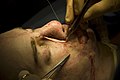 Transplantation eines kleinen Hautstückes aus der Brust im Rahmen einer Nasenverkleinerung