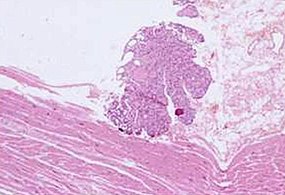 Cardiac muscle (bottom) with contamination from thyroid tissue (center)