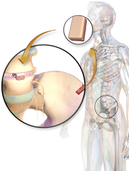 Bone grafting using an autograft.