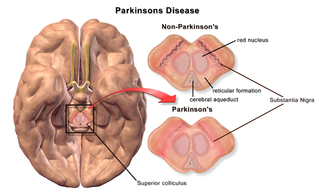 Parkinson's disease.