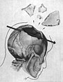 Trayectoria del proyectil que atravesó el cráneo del presidente estadounidense John F. Kennedy. La bala atravesó la parte posterior del hueso parietal en dirección postero-anterior.