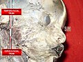 Facial nerve at foetus