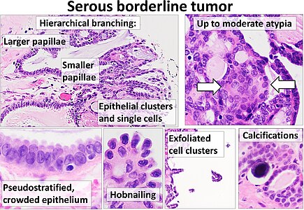 Histopathology of the typical features of an ovarian serous borderline tumor: Hierarchical branching, exfoliated cell clusters, calcifications, up to moderate atypia, and pseudostratified, crowded epithelium with hobnailing. H&E stain.