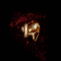 Darstellung von Labyrinth und Nervus vestibulocochlearis (VIII) als 3D-Animation nach MRT-Bildern