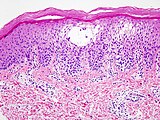 Histologisches Bild eines subkornealen Bläschens bei Dyshidrosis