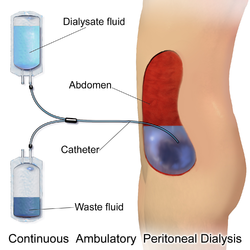 Continuous ambulatory peritoneal dialysis.