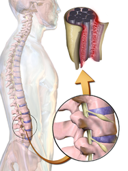 Arachnoiditis.