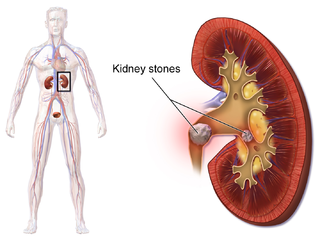 Kidney stones.