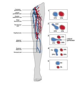 Vascular anatomy for deep venous thrombosis (DVT) point of care ultrasound (POCUS)