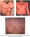 Some more severe pimples can lead to significant swelling and may appear on the back and chest.