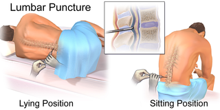 Lumbar puncture.