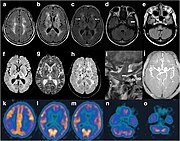 Tekstissä mainitun egyptiläissyntyisen miehen aivokuvaus. MRI-kuvien mukaan otsalohkossa poikkeavuuksia. MRA osoitti pienempiä aivovaltimoiden distaalisia haaroja.