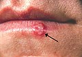 Herpes labialis