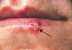 Herpes(PHIL 1573 lores).jpg