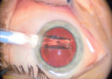 The lens can be seen protruding from the nozzle tip through the pupil as it is ejected