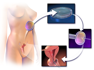 In vitro fertilization (IVF) with intracytoplasmic sperm injection (ICSI).