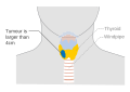 Stage T3 thyroid cancer