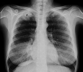 Рентгенограмма органов грудной клетки, опухоль Панкоста (обозначена P, немелкоклеточная карцинома правого лёгкого) у курящей женщины 47 лет.