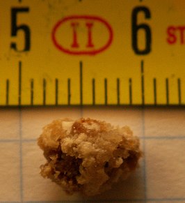 Een 8 mm grote niersteen