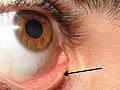 Ponto lacrimal inferior em evidência.