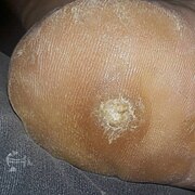 Deep plantar wart on heel