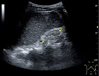 End-stage chronic kidney disease with increased echogenicity, homogenous architecture without visible differentiation between parenchyma and renal sinus and reduced kidney size. Measurement of kidney length on the US image is illustrated by '+' and a dashed line.[57]