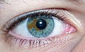 Heterocromia setorial