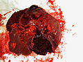 Thumbnail for Splenic injury