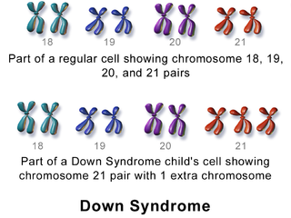 Karyotyoe in Down syndrome.