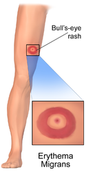 Rash of Lyme disease.