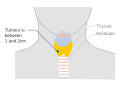 Stage T1b thyroid cancer