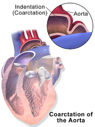 Coarctation of the aorta.