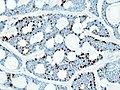 唾液腺に生じた腺様嚢胞癌の病理組織像。 S-100タンパク質による免疫染色。