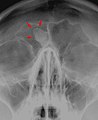 Osteoma del si frontal vist en la radiografia