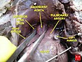Fetusna uzlazn aorta