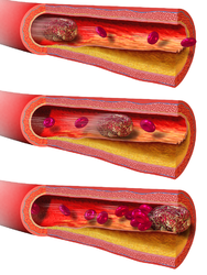 Blood clot motion.