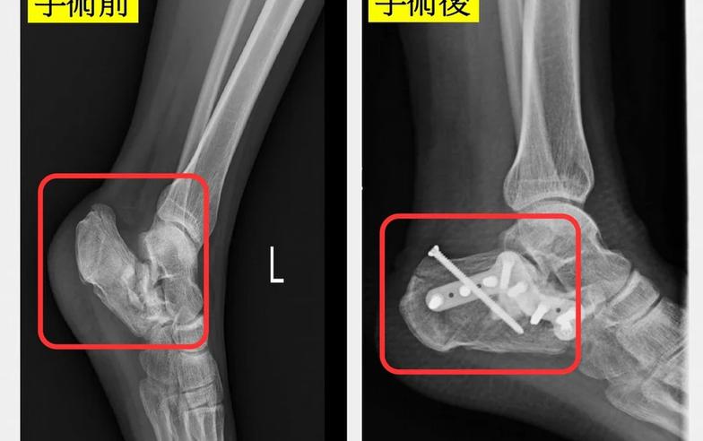 女騎車自摔「腳扭曲變形」險休克⋯醫揭「腳跟骨骨折」併發症超多