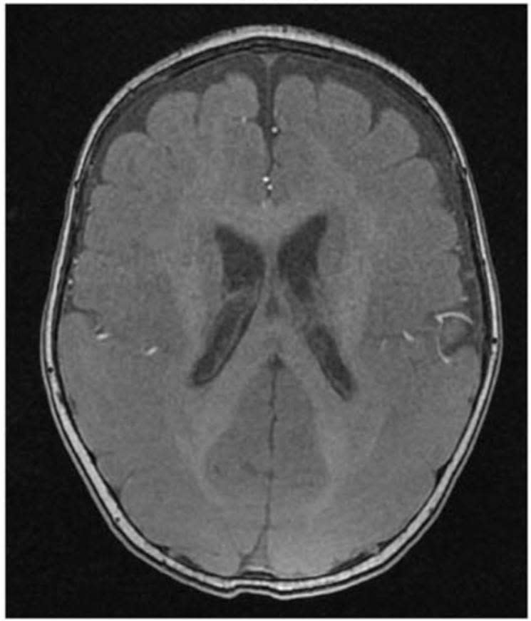 病人大腦後面枕葉區為主的腦迴消失和增厚，臨床上診斷為罕見的「平腦症」。（記者吳門鍵攝）